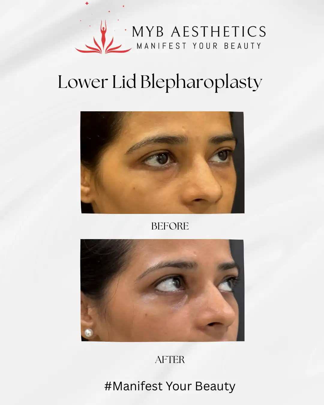 Under eye fat bags surgery before and after