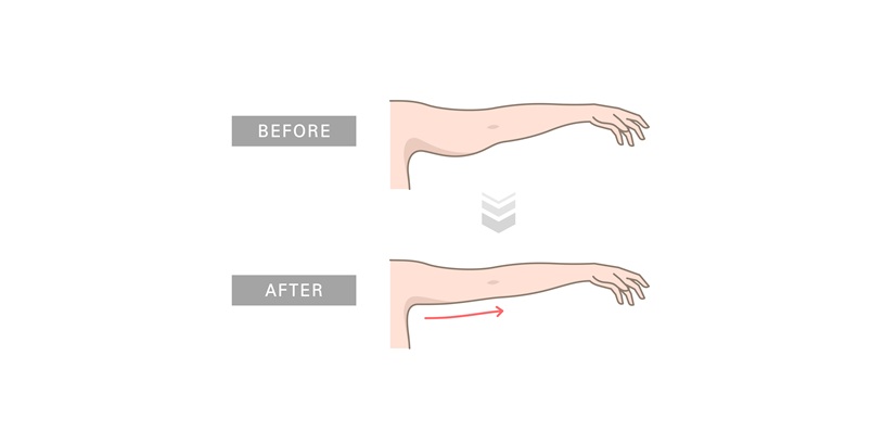 FAQs About Arm Liposuction in Mumbai