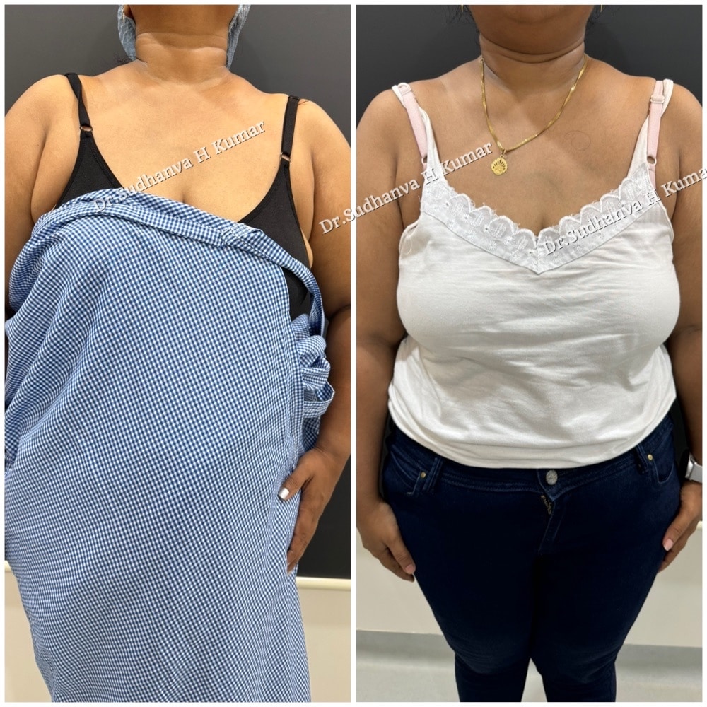 Before after axillary breast