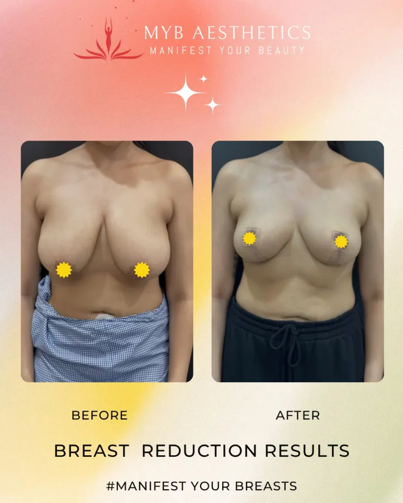 Breast Reduction Patient 1 Before and after image front profile