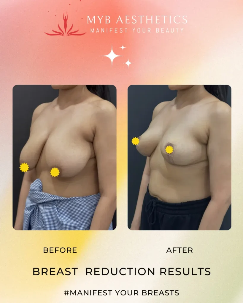 Breast Reduction Patient 1 Before and after image left profile
