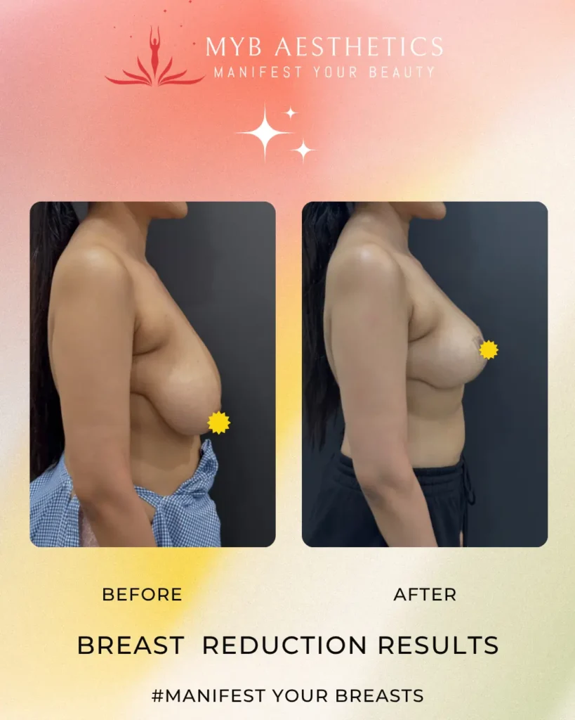 Breast Reduction Patient 1 Before and after image left side profile Copy