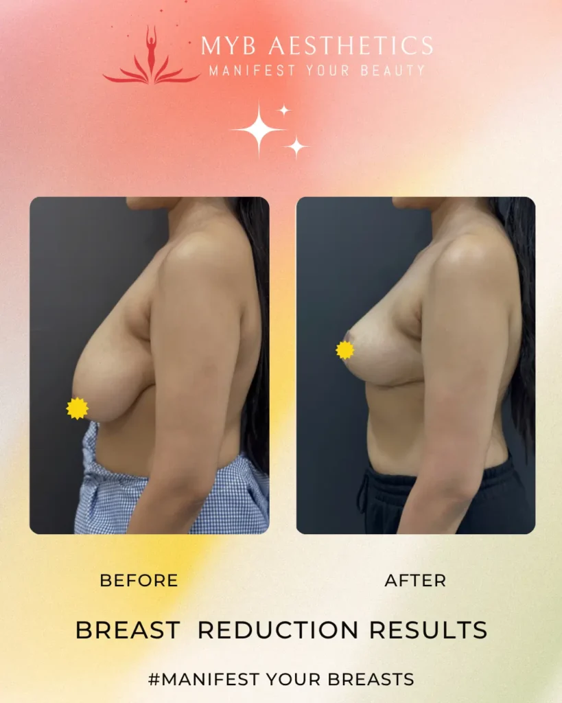 Breast Reduction Patient 1 Before and after image right side profile Copy