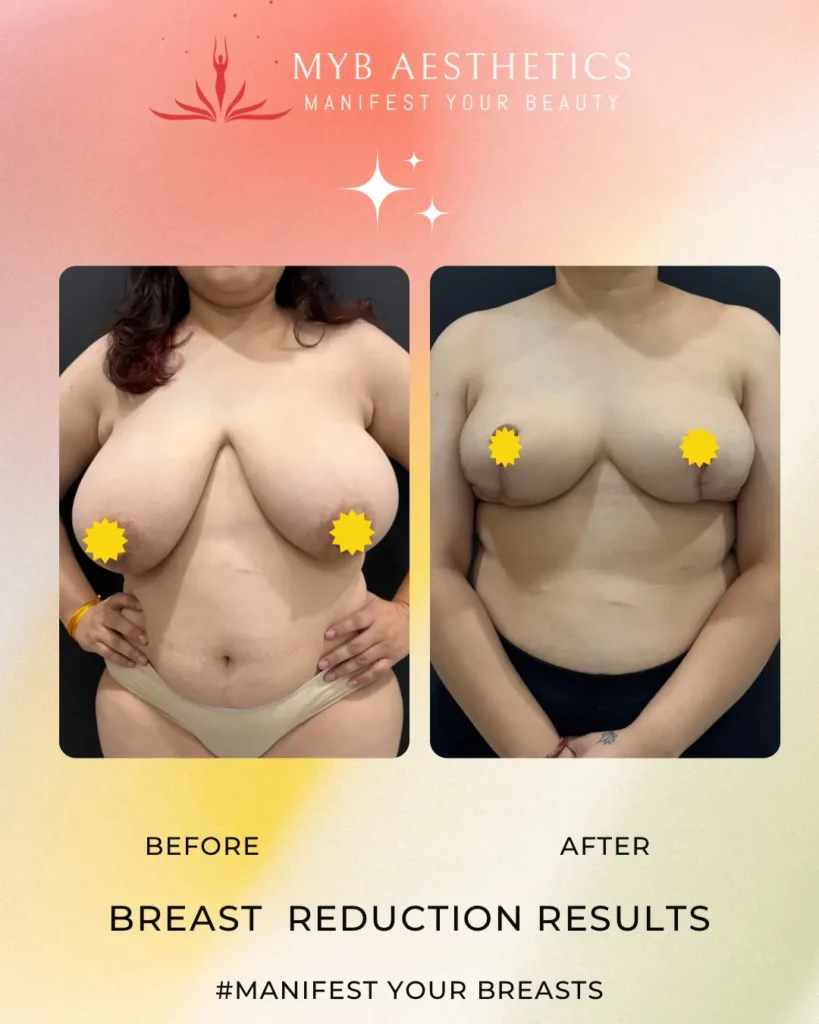 Breast Reduction Results Patient 2 Before and after image front profile Copy