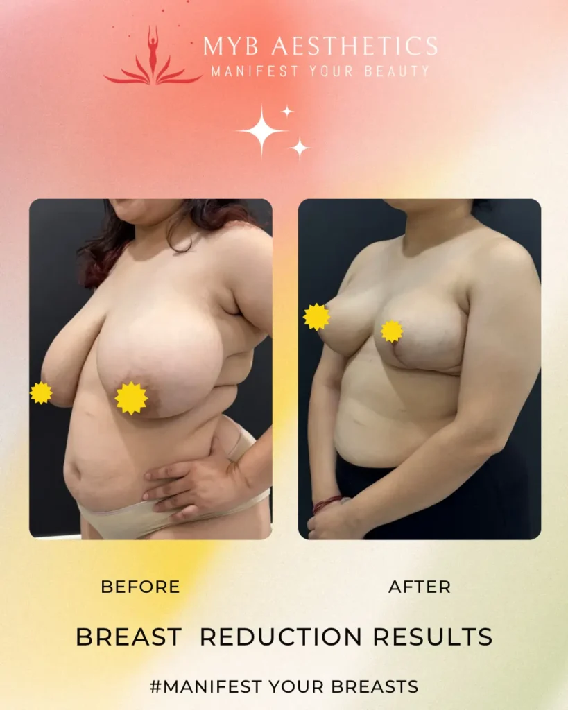Breast Reduction Results Patient 2 Before and after image left profile Copy