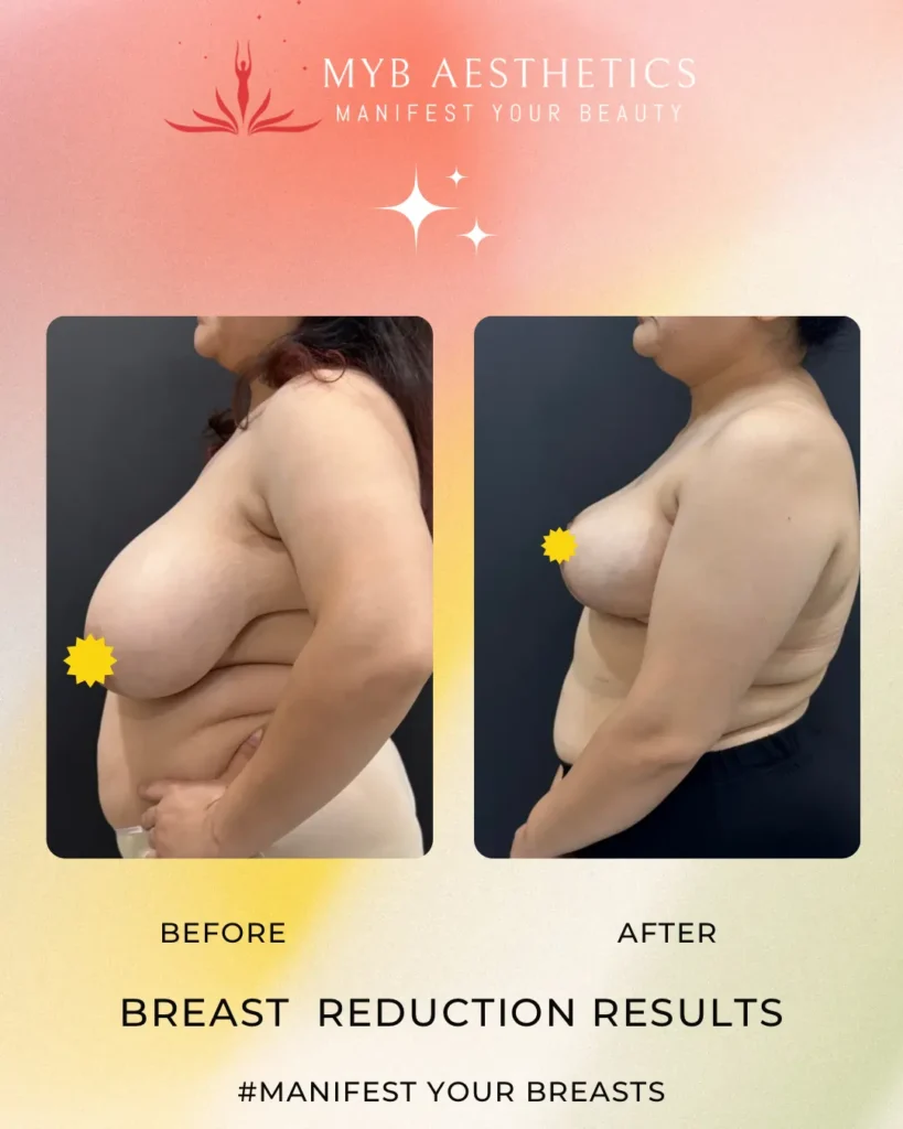 Breast Reduction Results Patient 2 Before and after image left side profile Copy