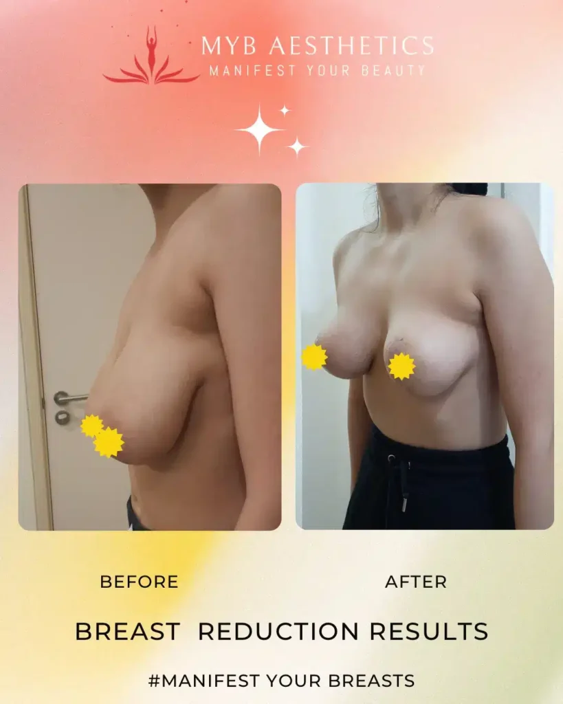 Copy of Breast Reduction is unquestionably 2 Copy