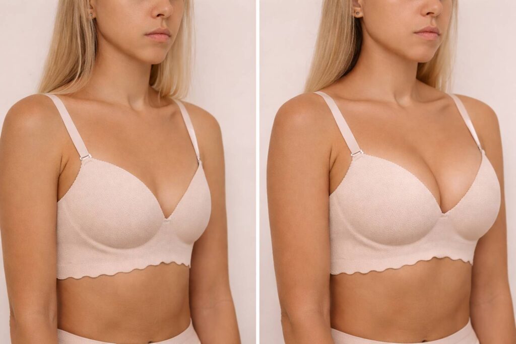 breast augmentation compressed 1mb
