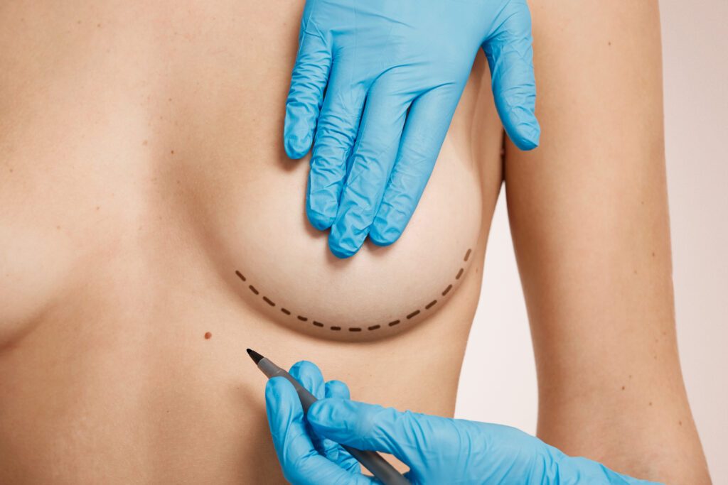 woman marked out cosmetic surgery