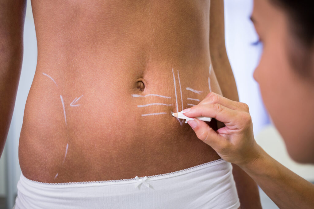 surgeon drawing lines womans abdomen liposuction cellulite removal